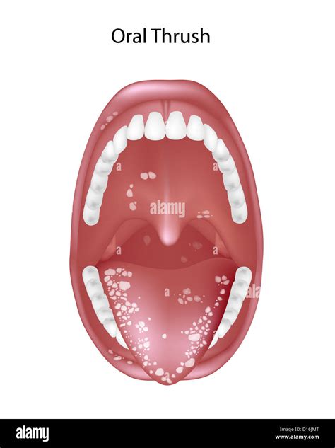 Oropharyngeal Candidiasis