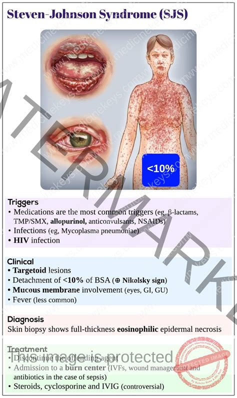 Steven-Johnson syndrome (SJS) - Medicine Keys for MRCPs