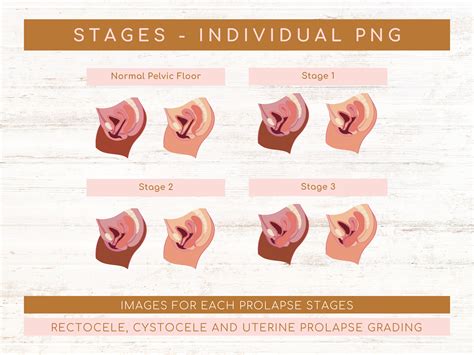 Types of Pelvic Organ Prolapse | Rectocele Stages | Cystocele Stages | Uterine Prolapse Stages ...