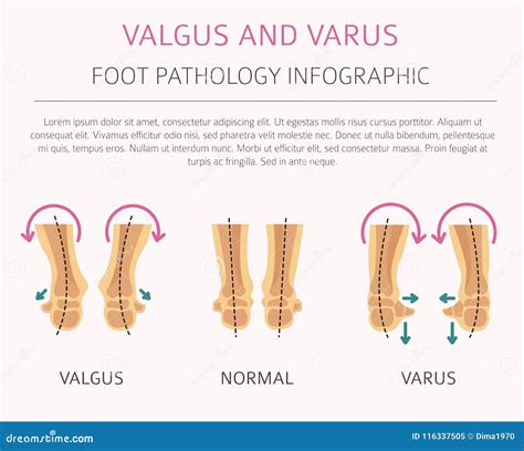 Varus Vs Valgus Fracture