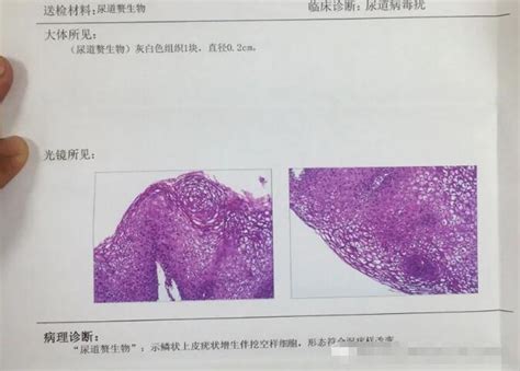 尖锐湿疹辨别图,丘疹尖锐湿疹症状图片,珍珠疹和尖锐辨别图片_大山谷图库