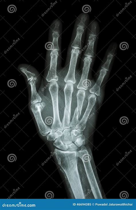 Multiple Fracture at Index,little Finger,metacarpal Bone Stock Image ...