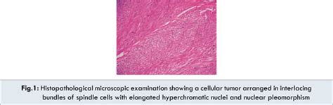 Uterine Leiomyosarcoma: a Management Dilemma