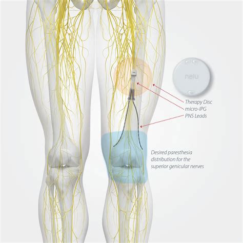 What Is A Nerve Stimulator Implant at Lydia Eddy blog