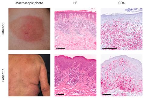T-Cell Receptor Rearrangements in Early Stages of Mycosis Fungoides May ...