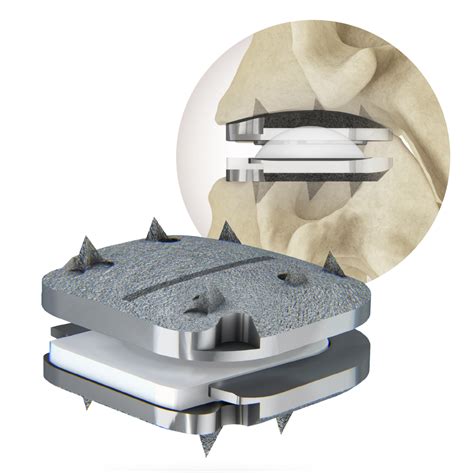 Cervical Disc Replacement - AOA Orthopedic Specialists