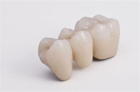 Posterior Porcelain fused to metal- 3 unit bridge | Dental lab, Dental ...