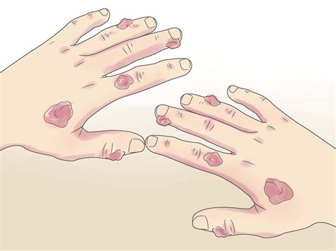 Trigger finger hurting – Artofit