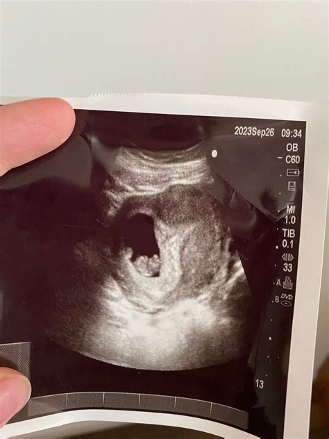 9 week ultrasound :) | BabyCenter