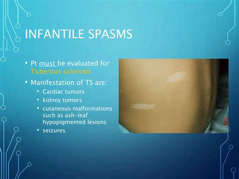 Infantile Spasms.ppt