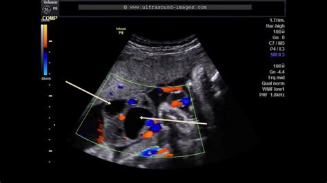 Bildergebnis für umbilical cord ultrasound images
