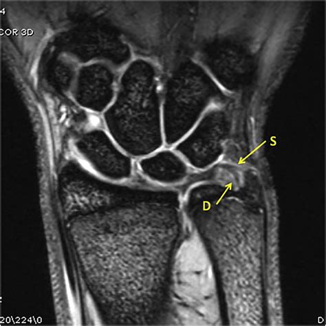 Triangular Fibrocartilage Complex Injuries in Children and Adolescents - Hand Clinics