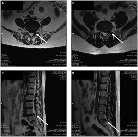 Lumbar Disc Herniation L5 S1