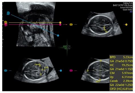 Applications of Advanced Ultrasound Technology in Obstetrics