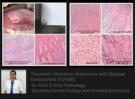 TUGSE — ORAL PATHOLOGY-SAVEETHA