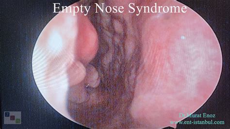Cool, Small, Dry Turbinate: Empty Nose Syndrome