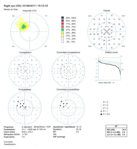 Image result for Visual Field Chart