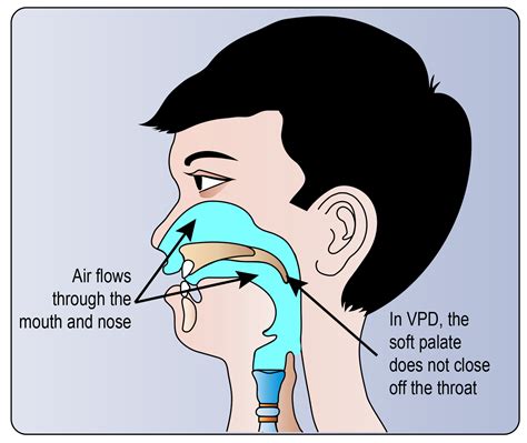 Velopharyngeal Incompetence Velopharyngeal Nasal Function And Speech