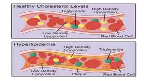 HYPERLIPIDEMIA | PPTX