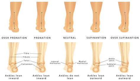 Pronation Of Foot