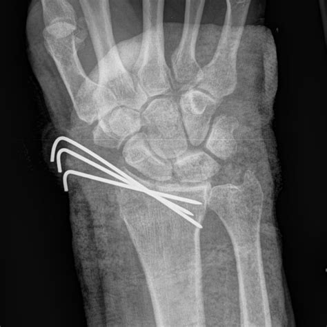 Distal Radius Fracture | The Bone School