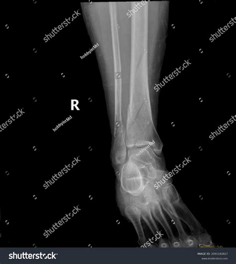 Fractures Distal Tibia Fibula X-ray Viewbroken Stock Photo 2091182827 | Shutterstock