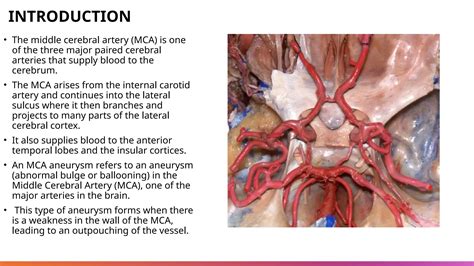 Medial cerebral artery anureysm presentation | PPTX