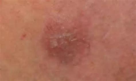 Minocycline Shows Promising for Treating Rare Skin Condition Granuloma ...