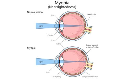 Astigmatism vs. Myopia: What's the Difference?