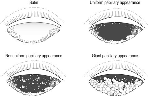 Giant Papillary Conjunctivitis - Clinical Tree