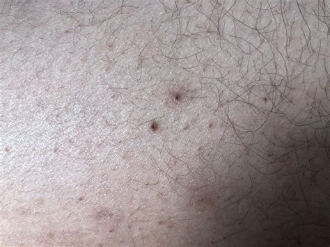 Popping Blackheads On Back