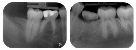 Immediate versus Delayed Implant Placement in Patients with Tooth ...