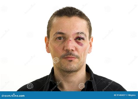 Broken nose and black eye stock image. Image of bend, hurt - 9140437