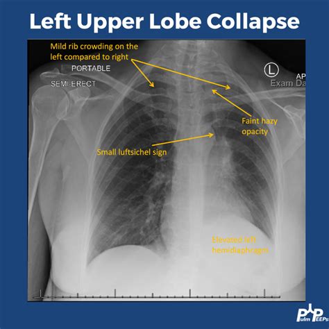 Radiology Rounds – 12/19/23 | PulmPEEPs