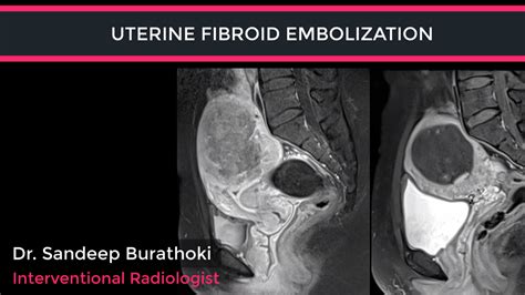 Fibroid Treatment in Dubai | Fibroids Treatment Dubai