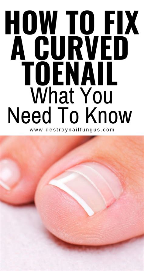 Curled Toenails Fix 的图像结果