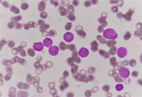 Blood disease - Anemias, Normocytic, Normochromic | Britannica