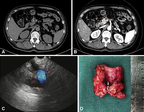 Unexpected cause of dilatation of the pancreatic duct - Gastrointestinal Endoscopy