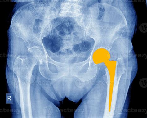 Complete hip implant surgery X-ray scan image of hip joints with ...