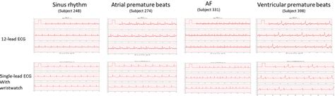 Image result for ECG Examples
