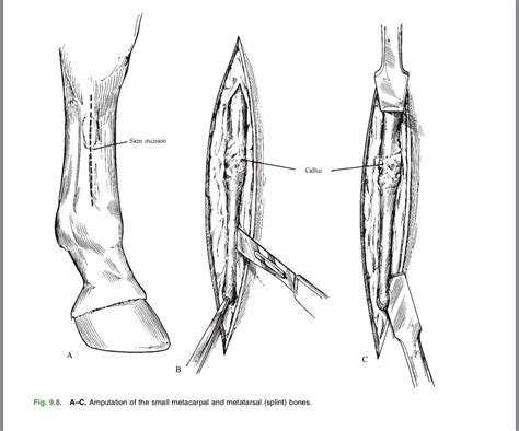 Splint Removal 的图像结果
