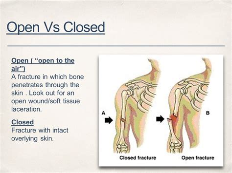 Open Reduction Vs Closed Reduction