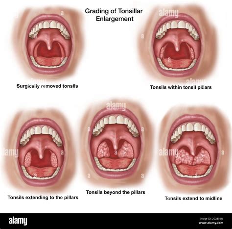 Various stages of tonsillar enlargement, looking into an open mouth ...