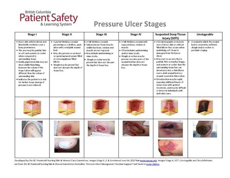 Pressure Ulcer Stage 2
