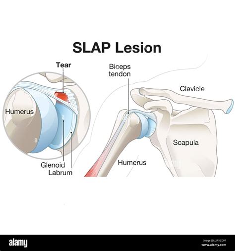 A SLAP lesion in the shoulder refers to an injury to the superior ...