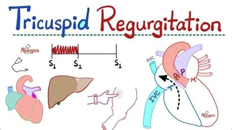 Tricuspid Regurgitation (Insufficiency) medical insights