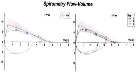 Pulmonary Large-Cell Neuroendocrine Carcinoma, a Multifaceted Disease ...