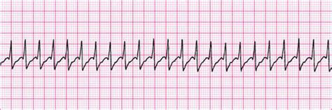 Image result for AHA SVT Algorithm
