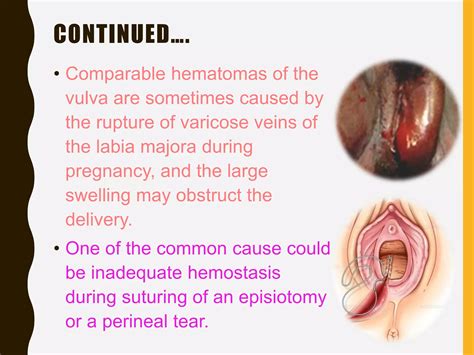 Genital tract injuries1 | PPTX