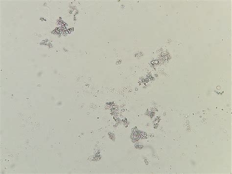 Amorphous Phosphate Crystals In Urine